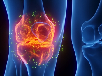 An illustration of inflammation around the knee.