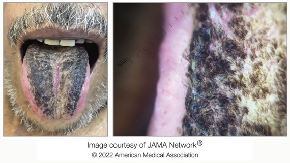 Thick, black 'hairs' coated a man's tongue. Here's why.