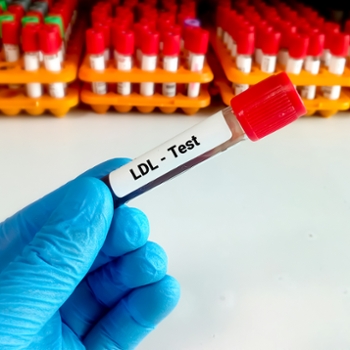 Photo illustration of a blood sample labeled for LDL testing.