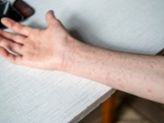 A teenager's hands covered in a measles rash.