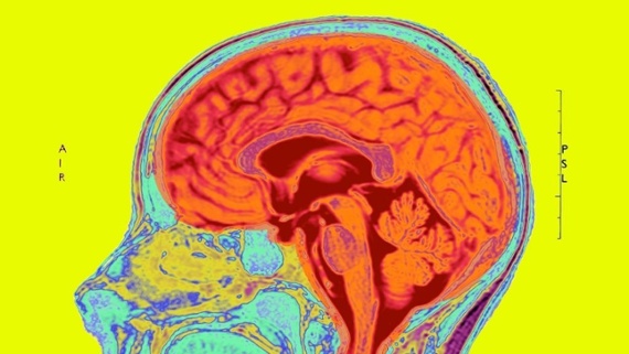 Brain shrinkage linked to COVID-19