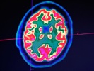 Artificial intelligence helps diagnose brain tumors