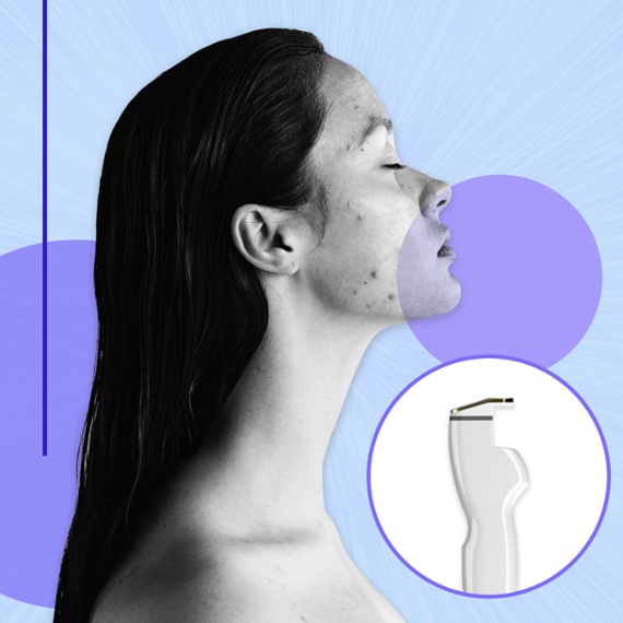 I Tried a First-of-Its-Kind Laser Treatment Designed to Permanently Cure Acne